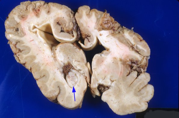 4A6 Polymicrogyria and hydrocephalus (Case 4) 9A