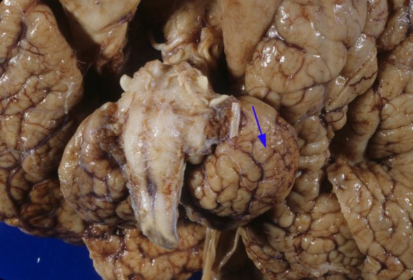 4A7 Polymicrogyria and hydrocephalus (Case 4) 12