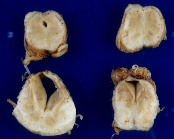 4A9 Polymicrogyria and hydrocephalus (Case 4) 16