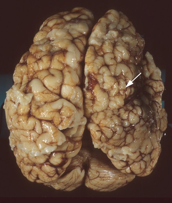 5A1 Polymicrogyria (Case 5) 2