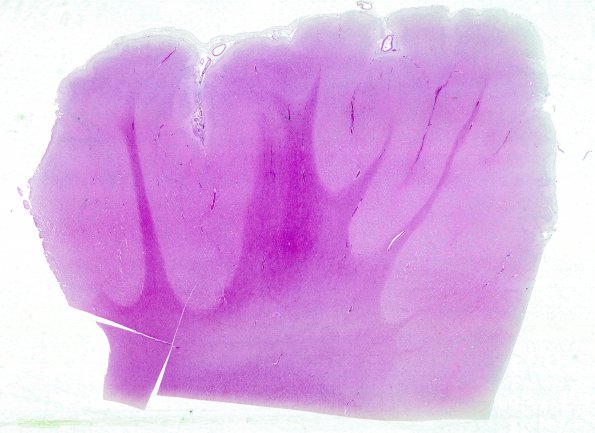 5B1 Polymicrogyria (Case 5) H&E whole mount