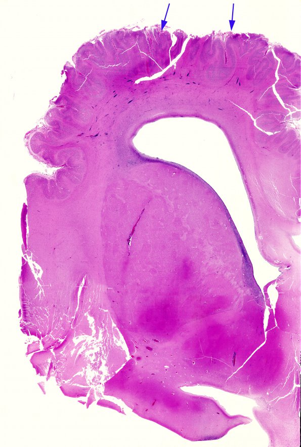 6B1 Polymicrogyria (Case 6) H&E 3