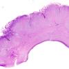 6B2 Polymicrogyria (Case 6) H&E 2