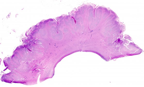 6B2 Polymicrogyria (Case 6) H&E 2