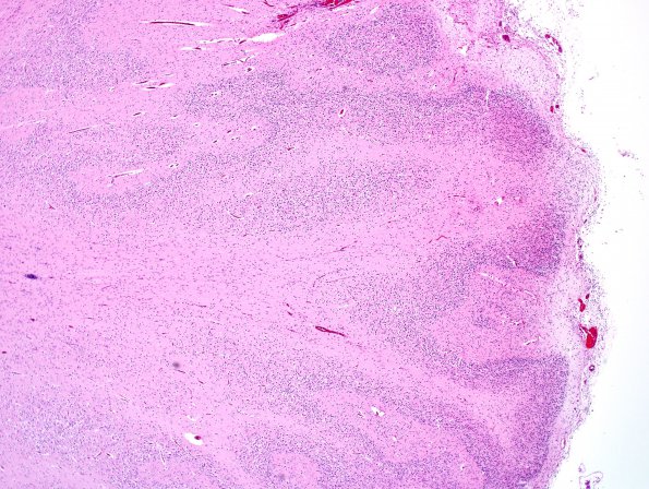 6B3 Polymicrogyria (Case 6) N1 H&E 3