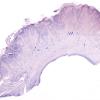 6C1 Polymicrogyria (Case 6) N1 NeuN whole mount 1