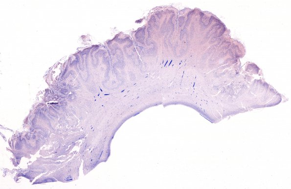 6C1 Polymicrogyria (Case 6) N1 NeuN whole mount 1