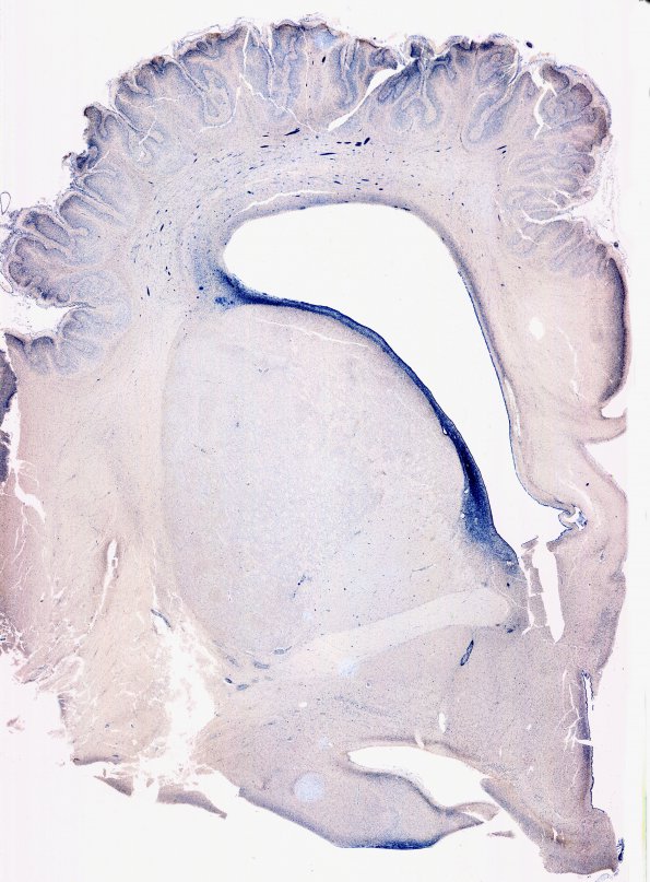 6C2 Polymicrogyria (Case 6) N15 NeuN whole mount 1