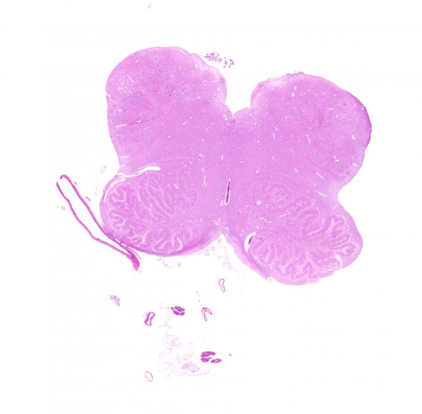 6D2 Polymicrogyria (Case 6) H&E 1