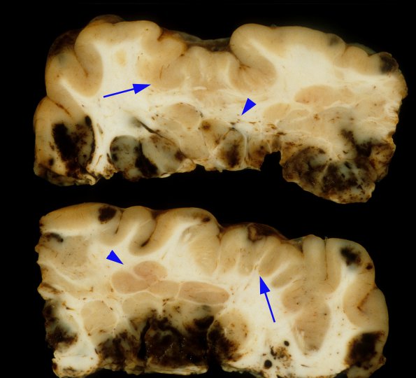 7A1 Polymicrogyria & Heterotopia, Cortical Resection Sz (Case 7) gross 4