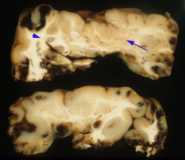 7A2 Polymicrogyria & Heterotopia, Cortical Resection Sz (Case 7) gross 5