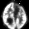 7B Polymicrogyria & Heterotopia (Case 7) PET Metabolic Scan