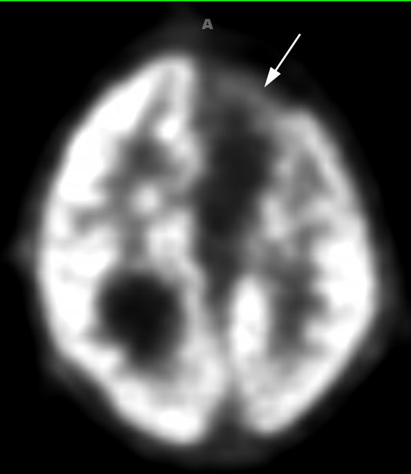 7B Polymicrogyria & Heterotopia (Case 7) PET Metabolic Scan