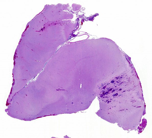 8A Polymicrogyria (Case 8) H&E 1