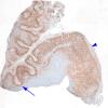 8B Polymicrogyria (Case 8) NeuN 1