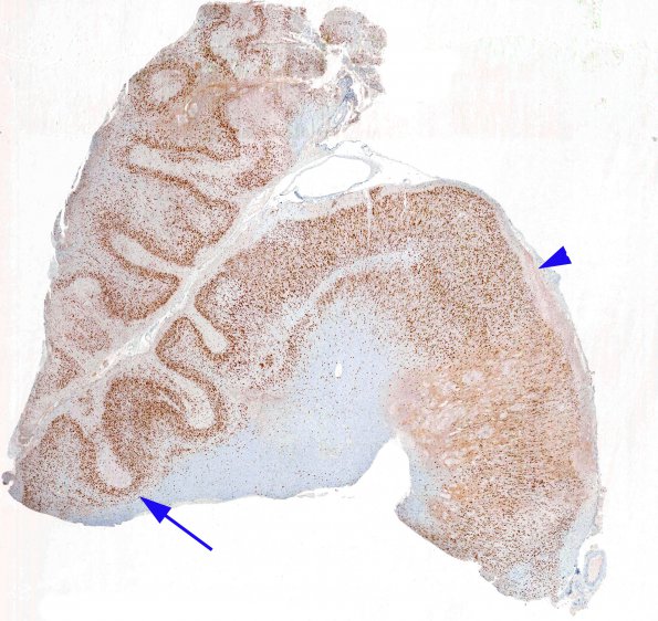 8B Polymicrogyria (Case 8) NeuN 1