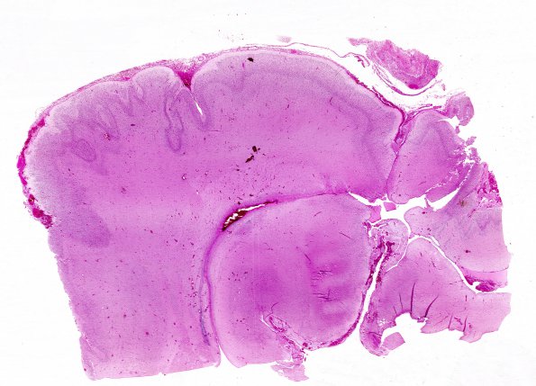 9B2 Polymicrogyria (Case 9) 1, 34 week gestation