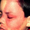 0A Sturge-Weber Syndrome - Port wine Stain (thanks Dr. Mort Smith)