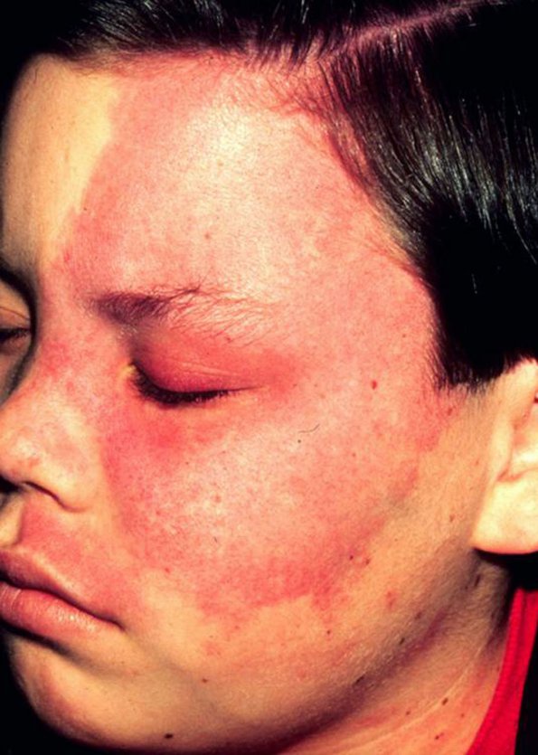 0A Sturge-Weber Syndrome - Port wine Stain (thanks Dr. Mort Smith)