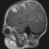 1A1 Sturge-Weber Syndrome (Case 1) T1 POST GAD 5