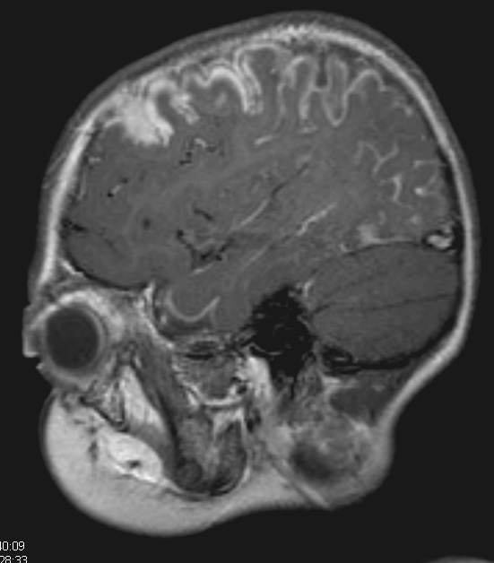 1A1 Sturge-Weber Syndrome (Case 1) T1 POST GAD 5