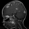 1A2 Sturge-Weber Syndrome (Case 1) T1 POST GAD 7