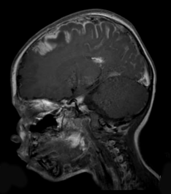 1A2 Sturge-Weber Syndrome (Case 1) T1 POST GAD 7