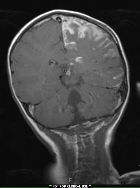 1A3 Sturge-Weber Syndrome (Case 1) T1 POST GAD