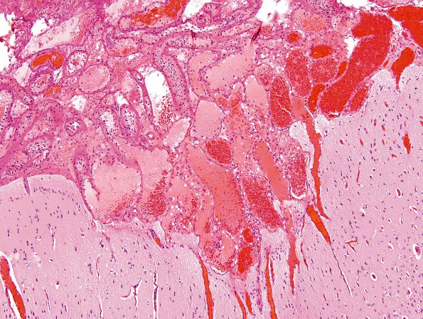 1B1 Sturge-Weber Syndrome (Case 1) 1