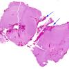 1B2 Sturge-Weber Syndrome (Case 1) A1 H&E whole mount