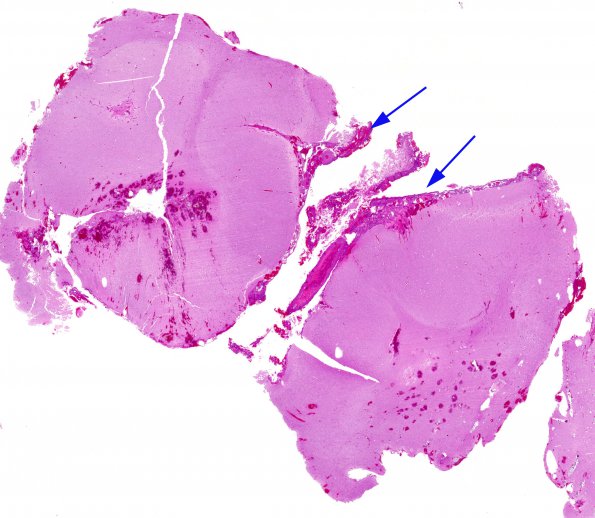 1B2 Sturge-Weber Syndrome (Case 1) A1 H&E whole mount