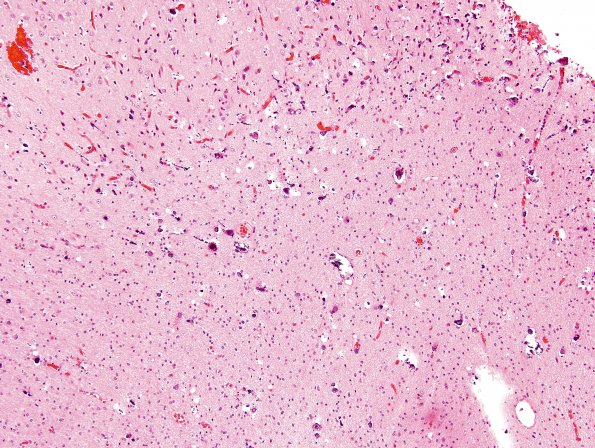 1C1 Sturge-Weber Syndrome (Case 1) 3