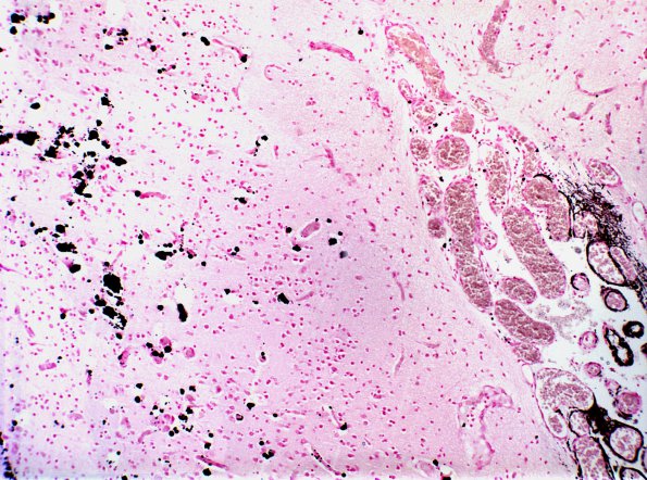 1C2 Sturge-Weber Syndrome (Case 1) Von Kossa A