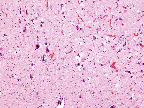 1C3 Sturge-Weber Syndrome (Case 1) 2