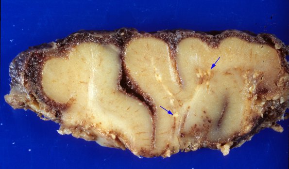 2A3 Sturge-Weber Syndrome (Case 2) 2