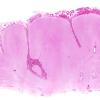 2B1 Sturge-Weber Syndrome (Case 2) H&E 1 whole mount A