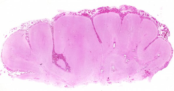 2B1 Sturge-Weber Syndrome (Case 2) H&E 1 whole mount A