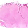 2B5 Sturge-Weber Syndrome (Case 2) a