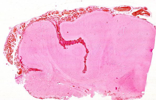 2B6 Sturge-Weber Syndrome (Case 2) H&E 2