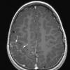 3A1 Sturge-Weber Syndrome (Case 3) T1 MPRAGE W