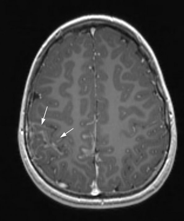 3A1 Sturge-Weber Syndrome (Case 3) T1 MPRAGE W