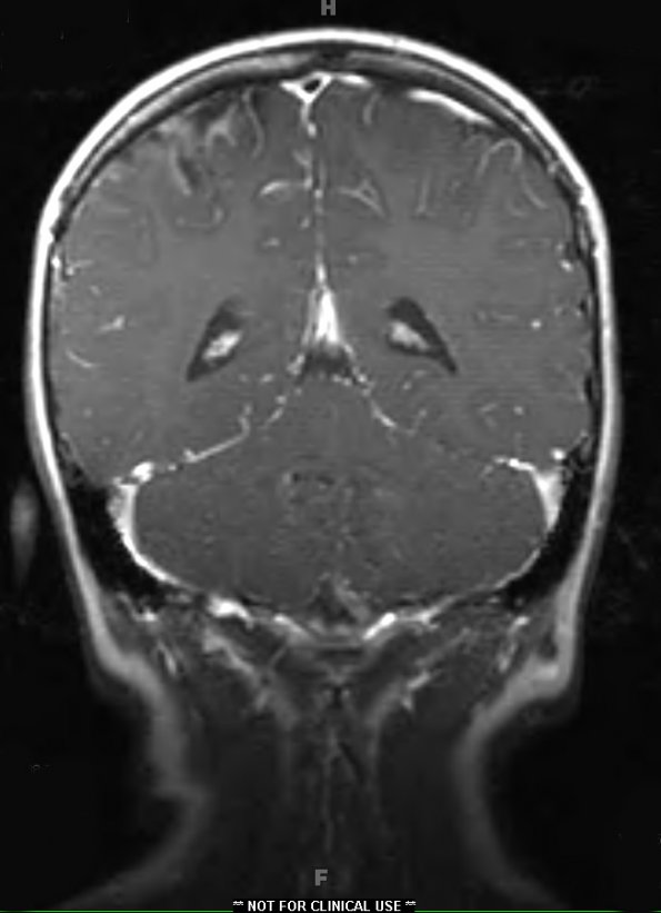 3A2 Sturge-Weber Syndrome (Case 3) T1 W 2