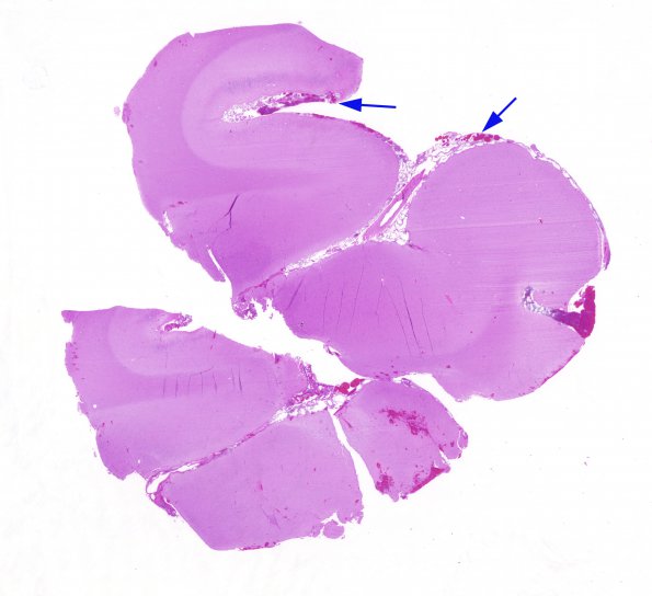 3B1 Sturge-Weber Syndrome (Case 3) H&E 5