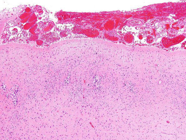 3B6 Sturge-Weber Syndrome (Case 3) H&E 18