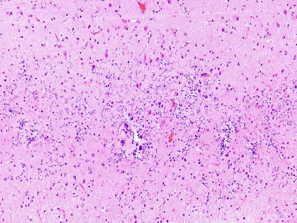 3B8 Sturge-Weber Syndrome Port wine (Case 3) H&E 2