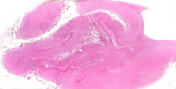 4A1 Sturge-Weber Syndrome & Leptomeningeal Melanoma (AANP 1971, Case 5) H&E X0.4 A