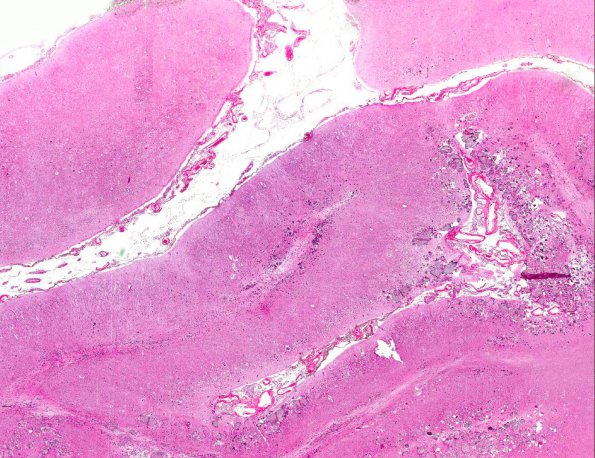 4A2 Sturge-Weber Syndrome & Leptomeningeal Melanoma (AANP 1971, Case 5) H&E X1 2A