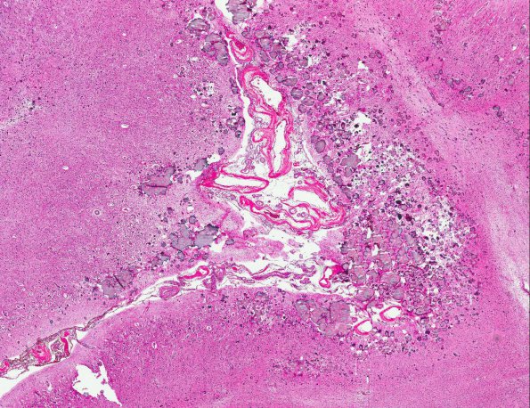 4A3 Sturge-Weber Syndrome & Leptomeningeal Melanoma (AANP 1971, Case 5) H&E X2 1