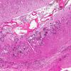 4A4 Sturge-Weber Syndrome & Leptomeningeal Melanoma (AANP 1971, Case 5) H&E X4 1