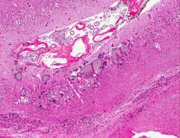 4A4 Sturge-Weber Syndrome & Leptomeningeal Melanoma (AANP 1971, Case 5) H&E X4 1